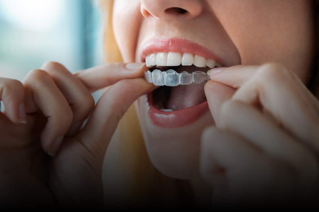 Photo of an invisalign